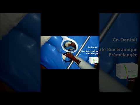 Coiffage pulpaire direct avec le WellRoot – Endodontie