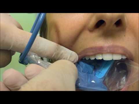 Radiografia Periapical com Posicionadores - Maxila Posterior