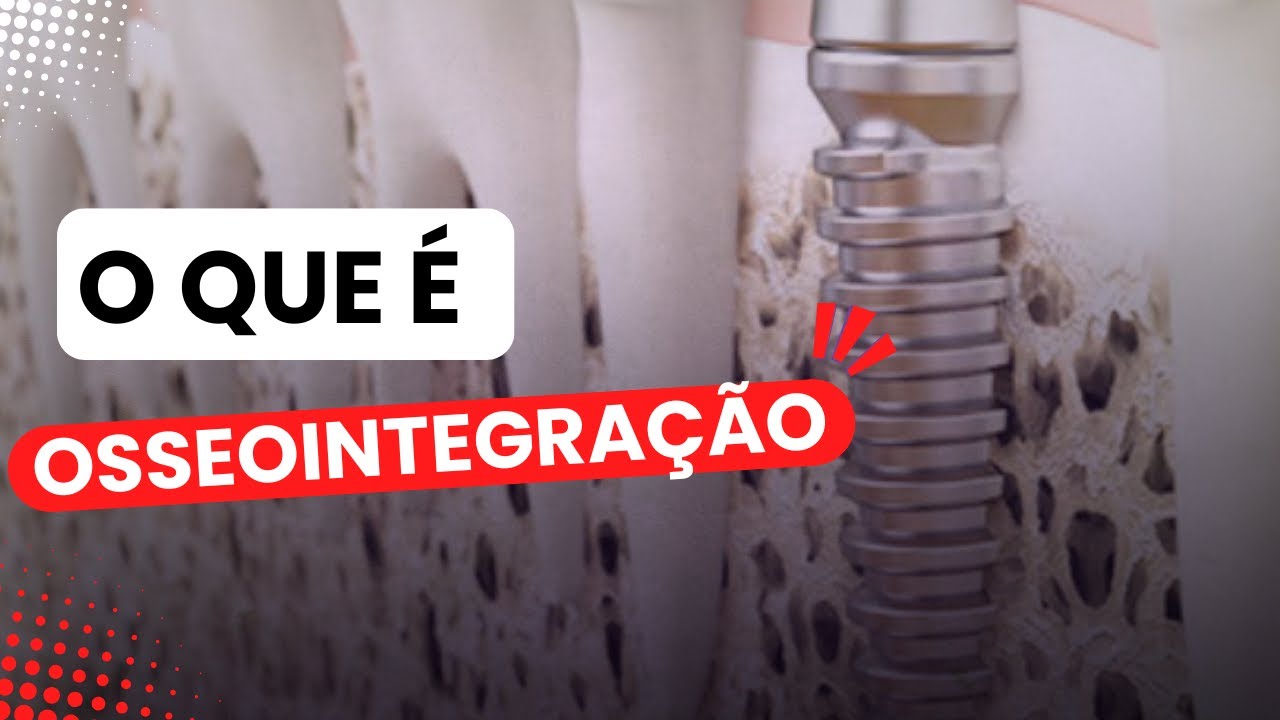 OSSEOINTEGRAÇÃO, A CICATRIZAÇÃO DO IMPLANTE