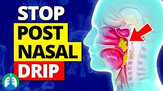 Top 10 Ways to Stop a Cough from Postnasal Drip