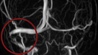 (English) Idiopathic Intracranial Hypertension with  Sinus Stenosis: PTA and Stenting.