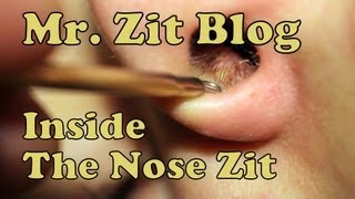 Difficult Pimple - Inside The Nose Zit Stabilized and HD 1080p