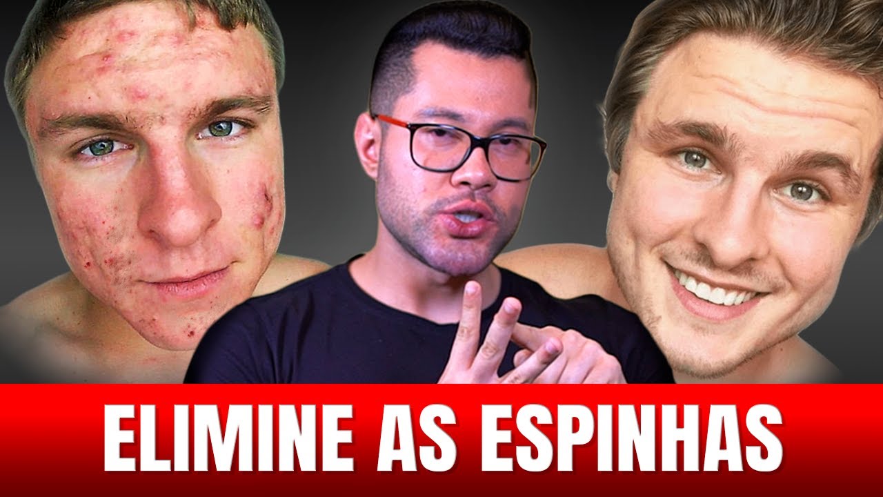 ACNE COM USO DE TESTO: 3 FORMAS SIMPLES DE ELIMINAR AS ESPINHAS