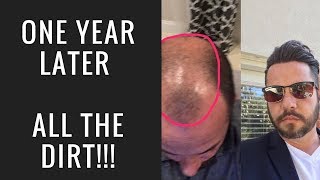 Hair Replacement Mens Hair System Review One Year Later, All The Dirt!!