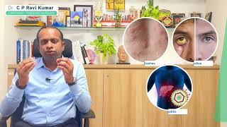 कार्बामाज़ेपीन आसान जानकारी | उपयोग, नुकसान, गर्भावस्था #epilepsyawareness #कार्बामाज़ेपीन