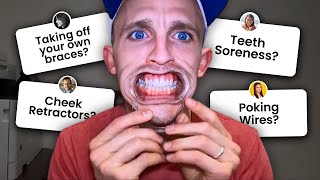 Watch this BEFORE Getting Braces...Braces Questions Answered