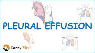 Pleural Effusion Causes ,Classification,Symptoms and Treatment