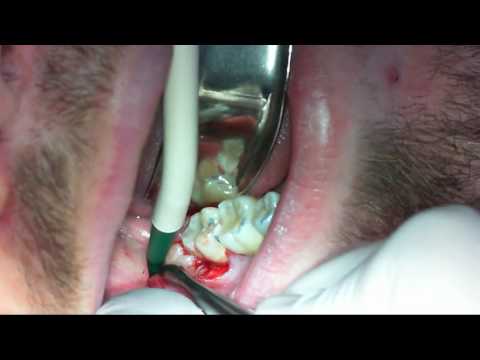 Chirurgiczna ekstrakcja zatrzymanego trzeciego zęba trzonowego (ząb 48)