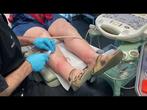 VARITHENA for an INCOMPETENT PERFORATOR