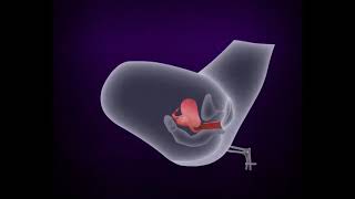 SGH IVF CARE 1 2 3 - How IVF is different from natural conception?