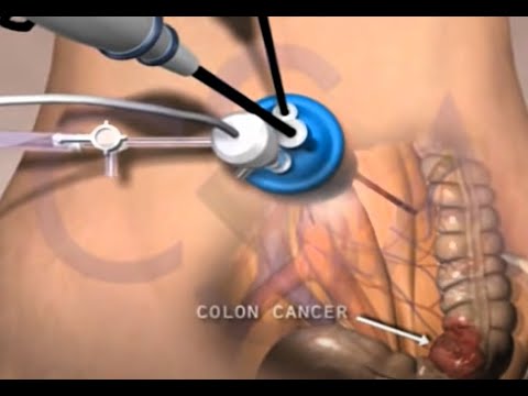 Single Incision Laparoscopic Surgery - SILS 3D Animation