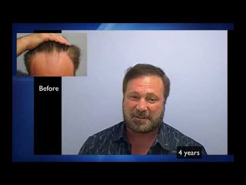 Hair transplant results after 4 years by Dr. Lindsey with interview | McLean | VA | Washington | DC thumbnail