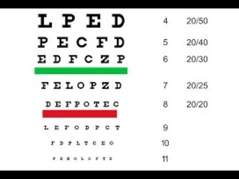 este posibilă restabilirea vederii la 18 viziunea 3 este hipermetropie sau miopie