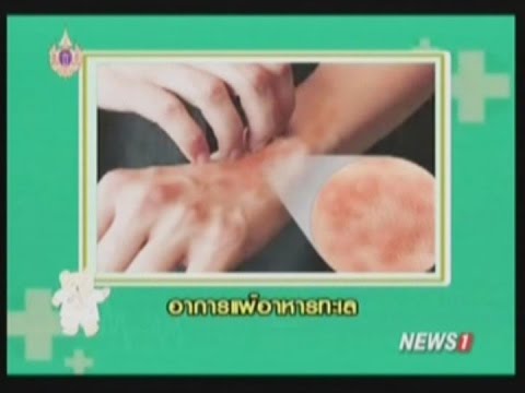 ขี้ผึ้งชีวจิต neurodermatitis ว่ายน้ำในโรคสะเก็ดเงิน