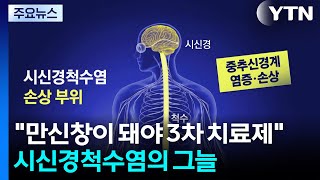 만신창이 돼야 3차 치료제...시신경척수염 환자의 그늘 / YTN