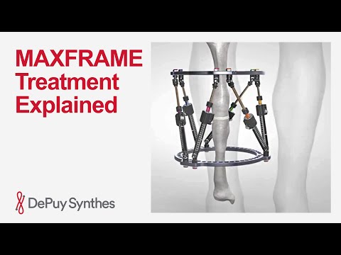 Fundamentals of Treatment with the MAXFRAME Multi-Axial Correction System | DePuy Synthes