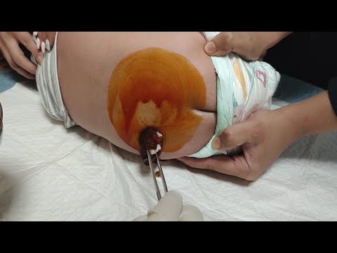 Lumbar puncture (LP) procedure | Spinal fluid tap