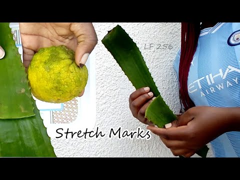 How to Remove Stretch Marks Lemon & Ekigajji Mugaba