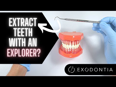 Using A Dental Explorer To Assist With Extractions 