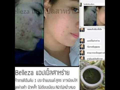 ร่างกายแห้งผิวกลาก การรักษาโรคสะเก็ดเงินบนหัว