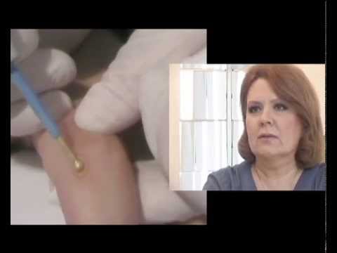 cum să rămâneți gravidă cu condiloame pastile antihelmintice pentru numele unei persoane