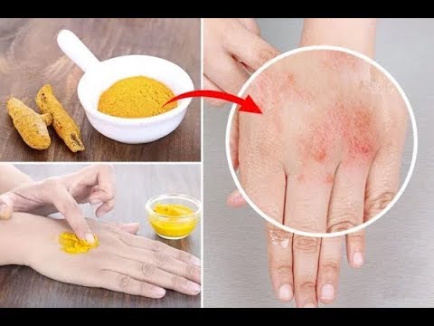 Dermatite di atopic raccomandazioni cliniche il 2010 Come curare leczema su un neumyvakina