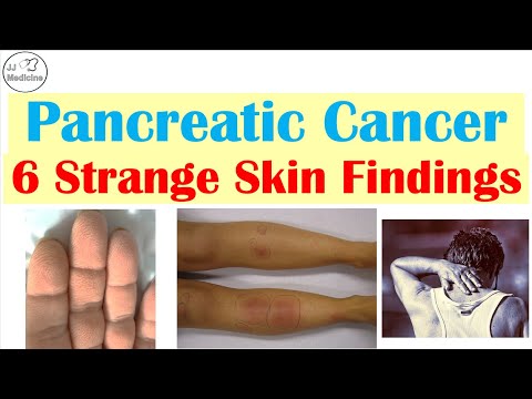 6 Skin Warning Signs of Pancreatic Cancer You Should Never Ignore