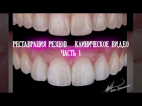 Реставрация фронтальных зубов. Клиническое видео. Часть 1