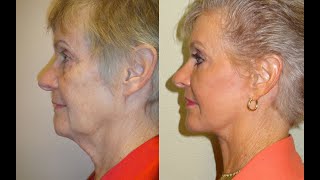 Secrets to Seamlessly Concealing Facelift Incisions: Unveil the Art of Invisible Healing!