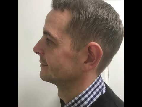 Skin tightening RF face treatment - Exeter clinic - Belgrave cosmetics