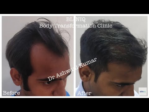 Patient Recovery Case — Video 4 (Liposuction)