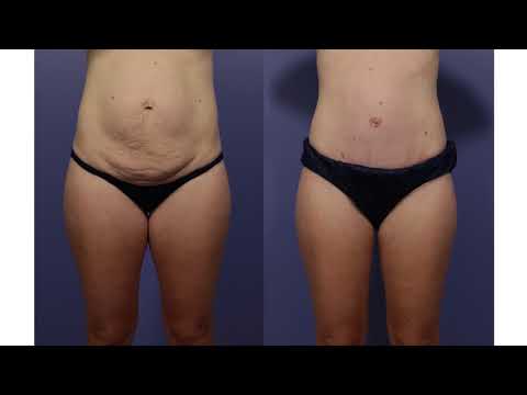download lagu mp3 mp4 Cheap Tummy Tuck In California, download lagu Cheap Tummy Tuck In California gratis, unduh video klip Cheap Tummy Tuck In California