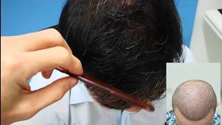 ปลูกผมFUE hair transplant Thailand by Dr. Kongkiat Laorwong, MD, FISHRS