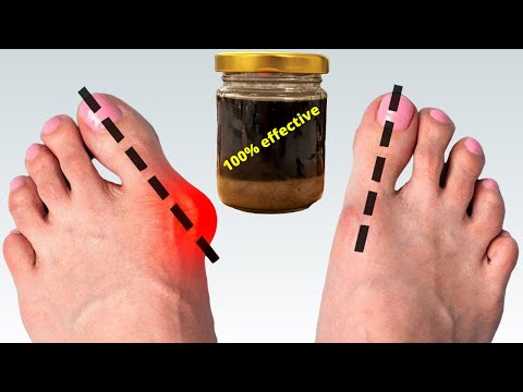 Removes uric acid! Straightens the foot bone.🔥Stop gout. Grandma always did that❗❗❗