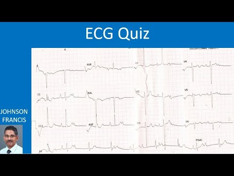 ECG Quiz