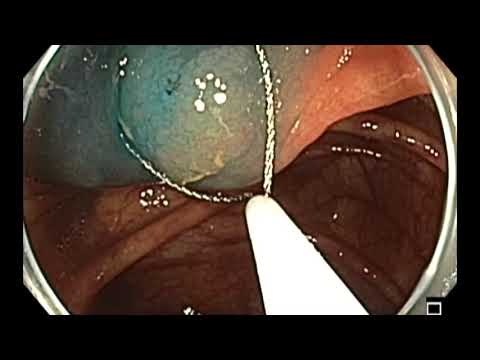 Colonoscopia - colon ascendente - SSA sutil - RME y cierre de clip