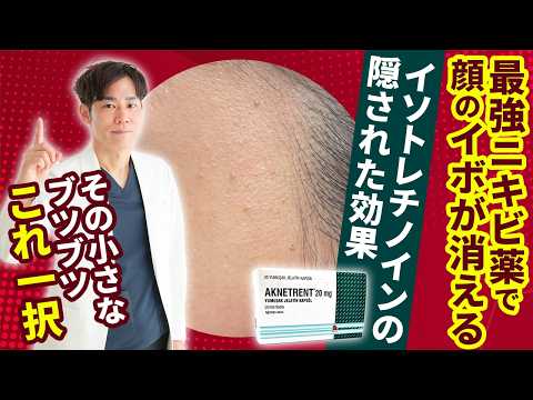 治らない顔のウイルス性イボ【扁平疣贅（へんぺいゆうぜい）】に重症ニキビ薬「イソトレチノイン」が効く？！ヨクイニンやレーザーで改善しない方への選択肢