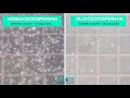 Oligozoospermia Low Sperm Count Comparison Of Normal Semen Sample With Sample With Low Count