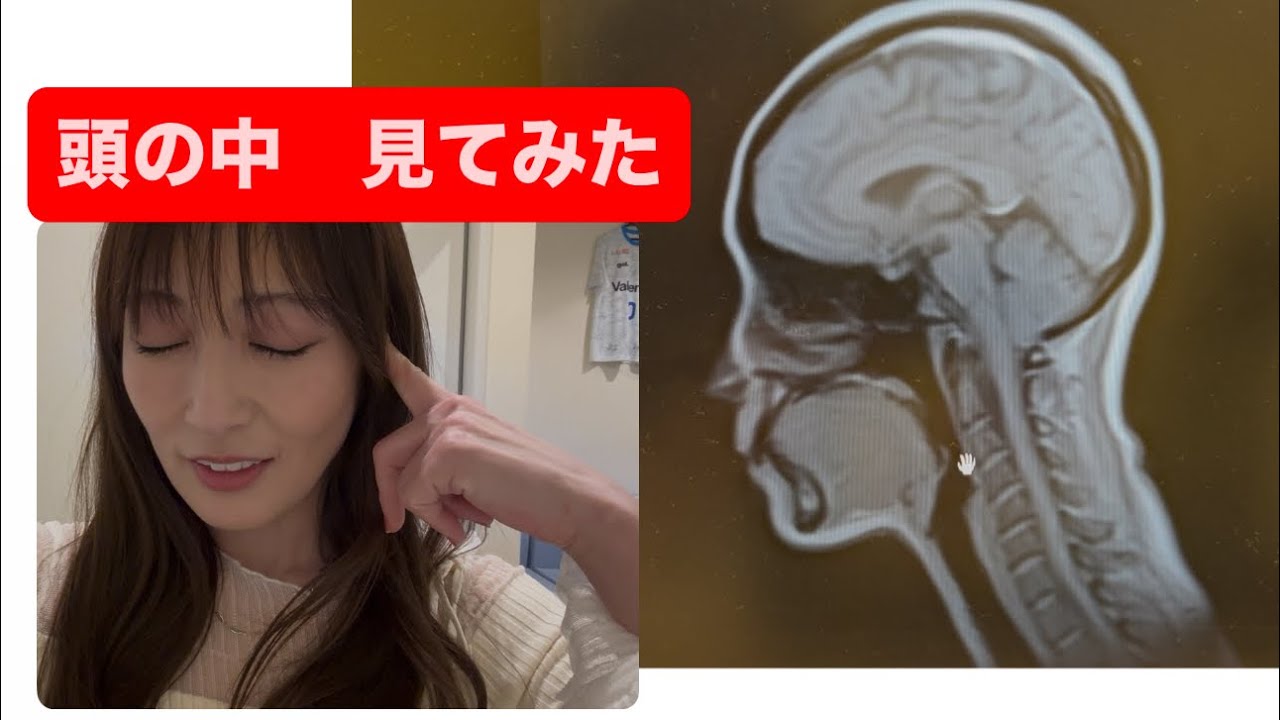 頭の中　見てみた〜MRI撮影後全解説〜