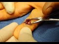 Live Surgery Foreign Body BB Removal From Finger