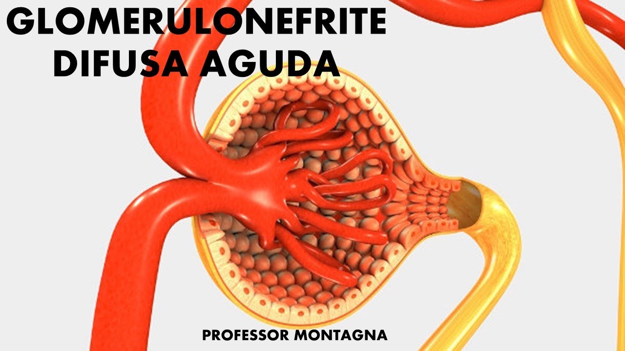 GLOMERULONEFRITE DIFUSA AGUDA