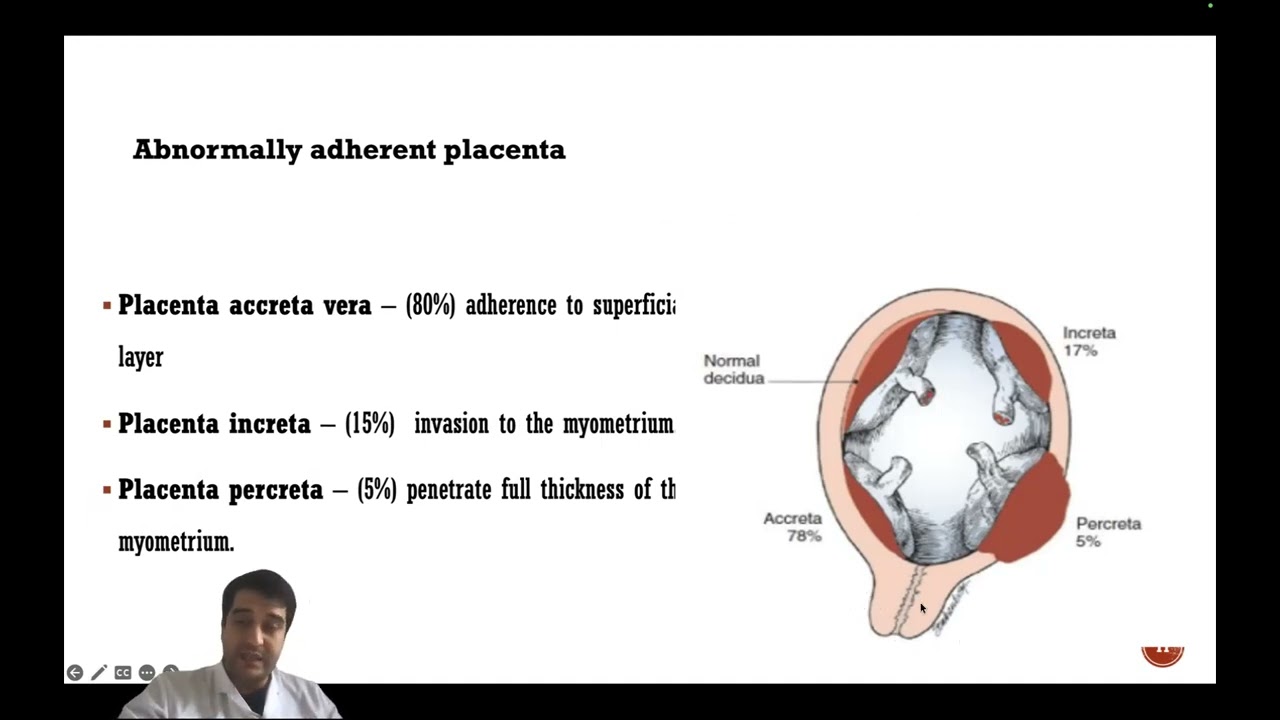 Postpartum hemorrhage
