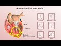 Advanced EKGs - Ventricular Tachycardia (Classification & Localization)