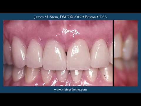 Porcelain Dental Veneers by James M.  Stein, D.M.D., Boston #1.1