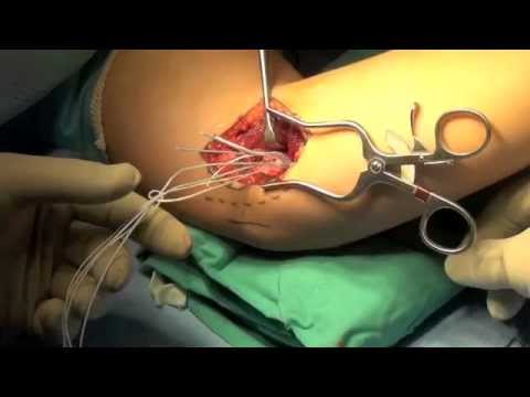 Elbow Ulnar Collateral Ligament Surgery - The Tommy John Surgery