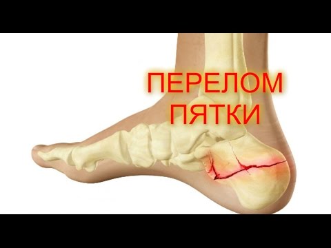 ПЕРЕЛОМ ПЯТКИ/Перелом пяточной кости Скорая помощь/переломы костей