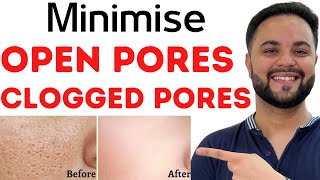 Open Pores,Clogged Pores & Enlarged Pores Solution with Home Remedies