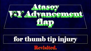 Atasoy V-Y Advancement flap, for thumb tip reconstruction.