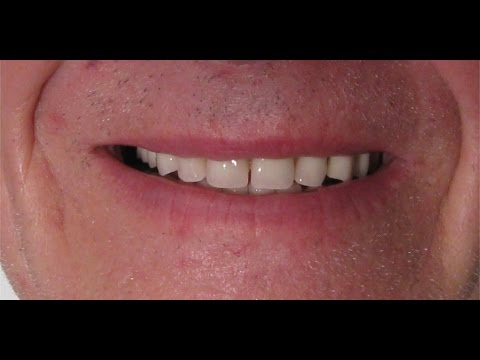 Fabrication de la barre sur implant par le prothésiste