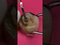 Root Canal Treatment Shorts
